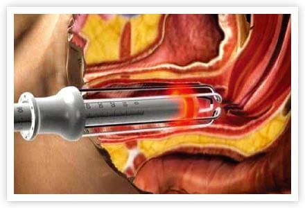 膣縮小治療イメージ