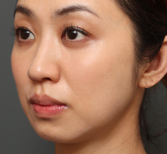 こけないバッカルファット除去のAfter