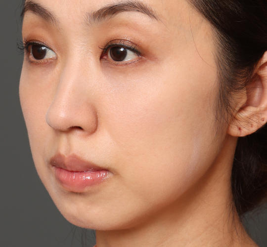 こけないバッカルファット除去のBefore