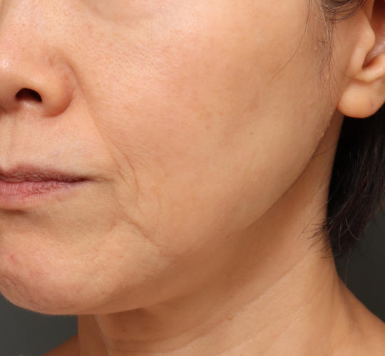 グロウHIFUセレクトプラスのAfter