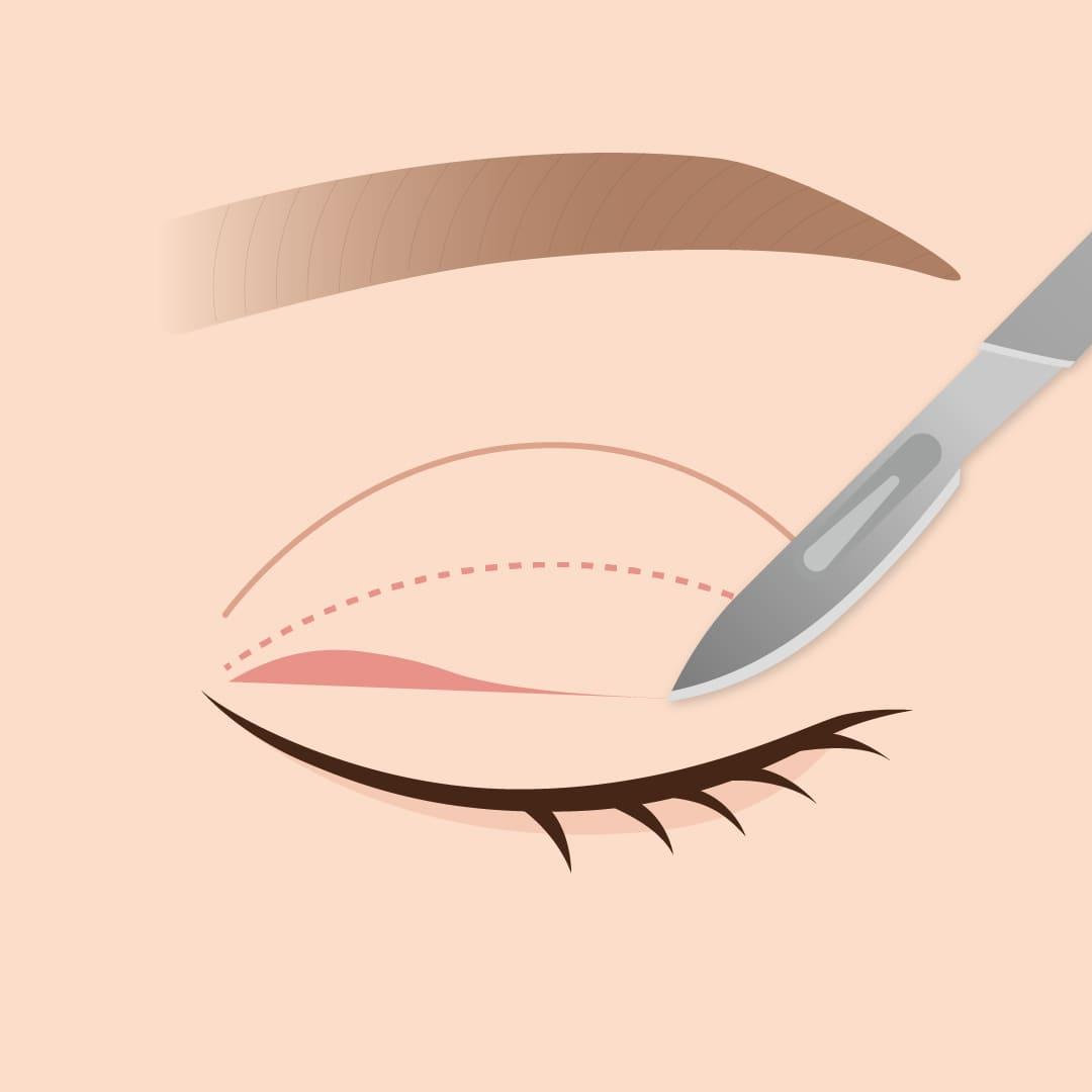 eye-correction_contents_05.jpg