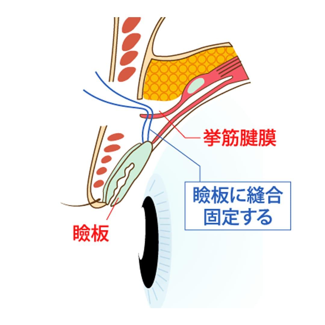 eye-correction_contents_07.jpg