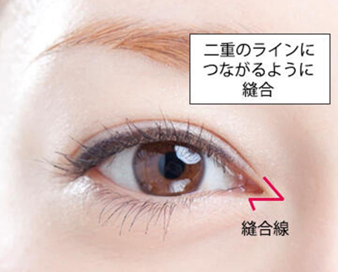 eye-correction_contents_08_02.jpg