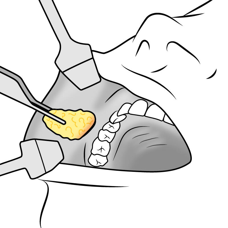 img-buccalfat-rearrangement-unique-04.jpg