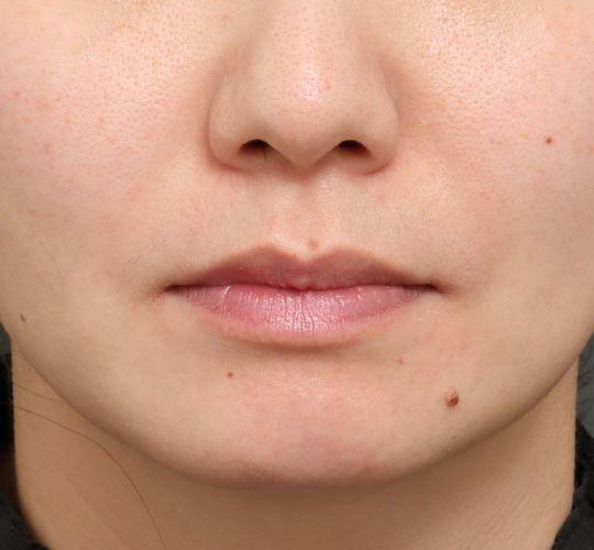 山影先生限定口角挙上モニターのBefore