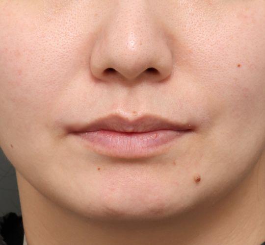 山影先生限定口角挙上モニターのAfter