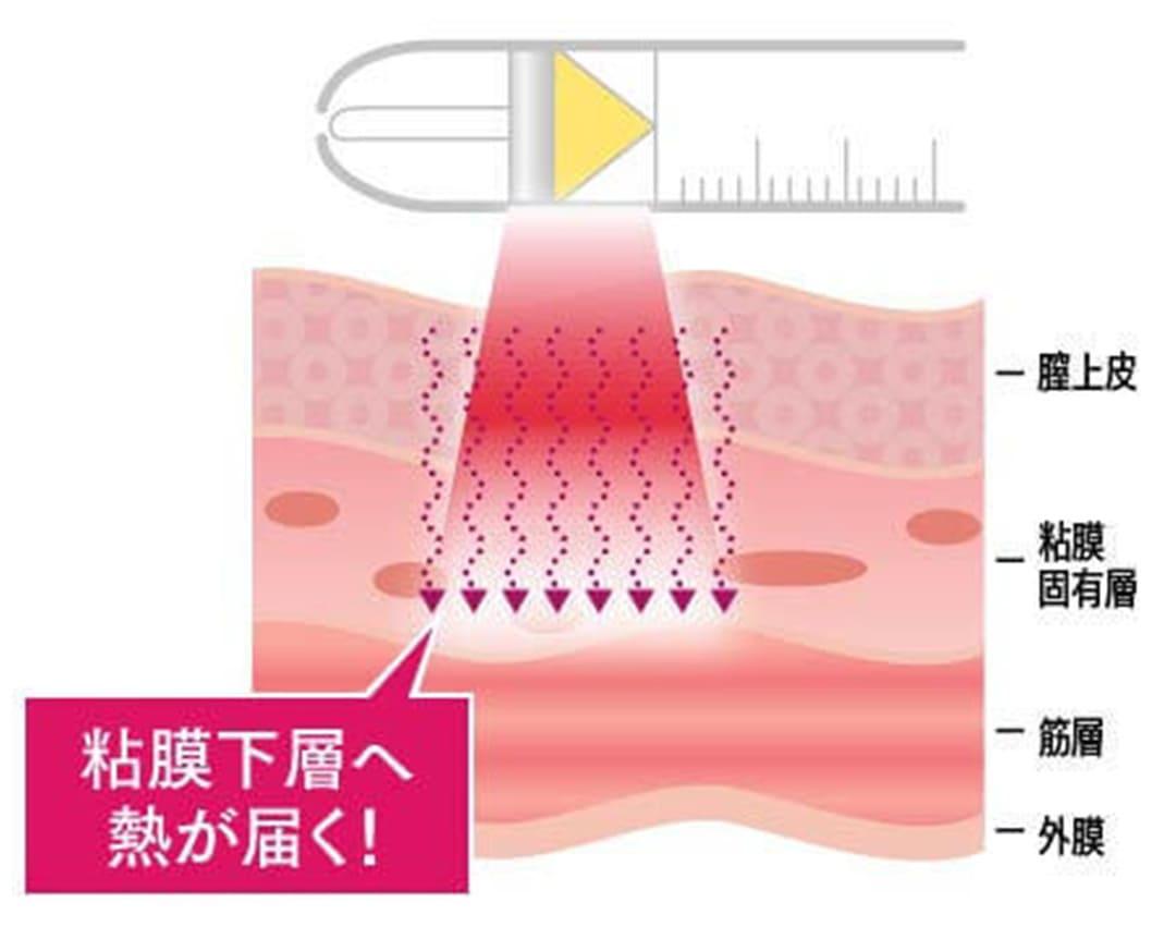 膣レーザー 公式 オザキクリニック 新宿 目黒祐天寺 羽村