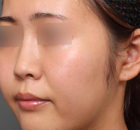 レチノールピールのAfter