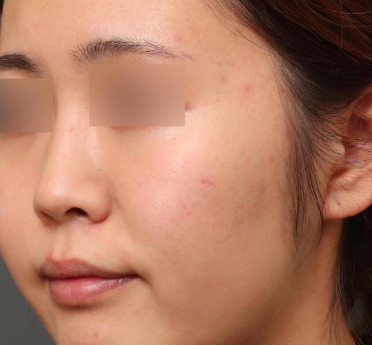 レチノールピールのBefore