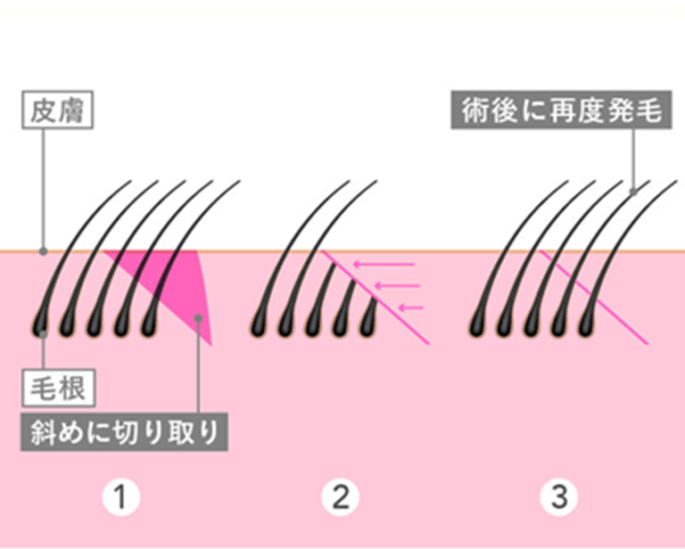 毛包斜切断