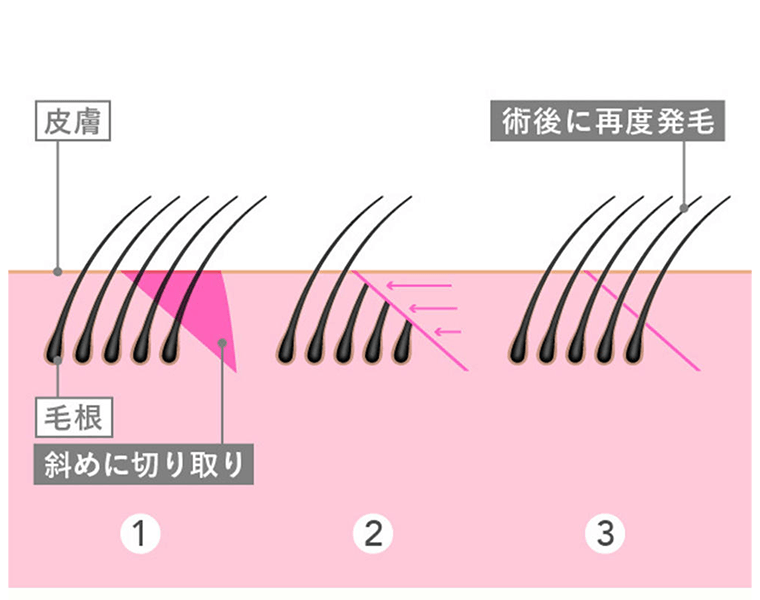 毛包斜切断法